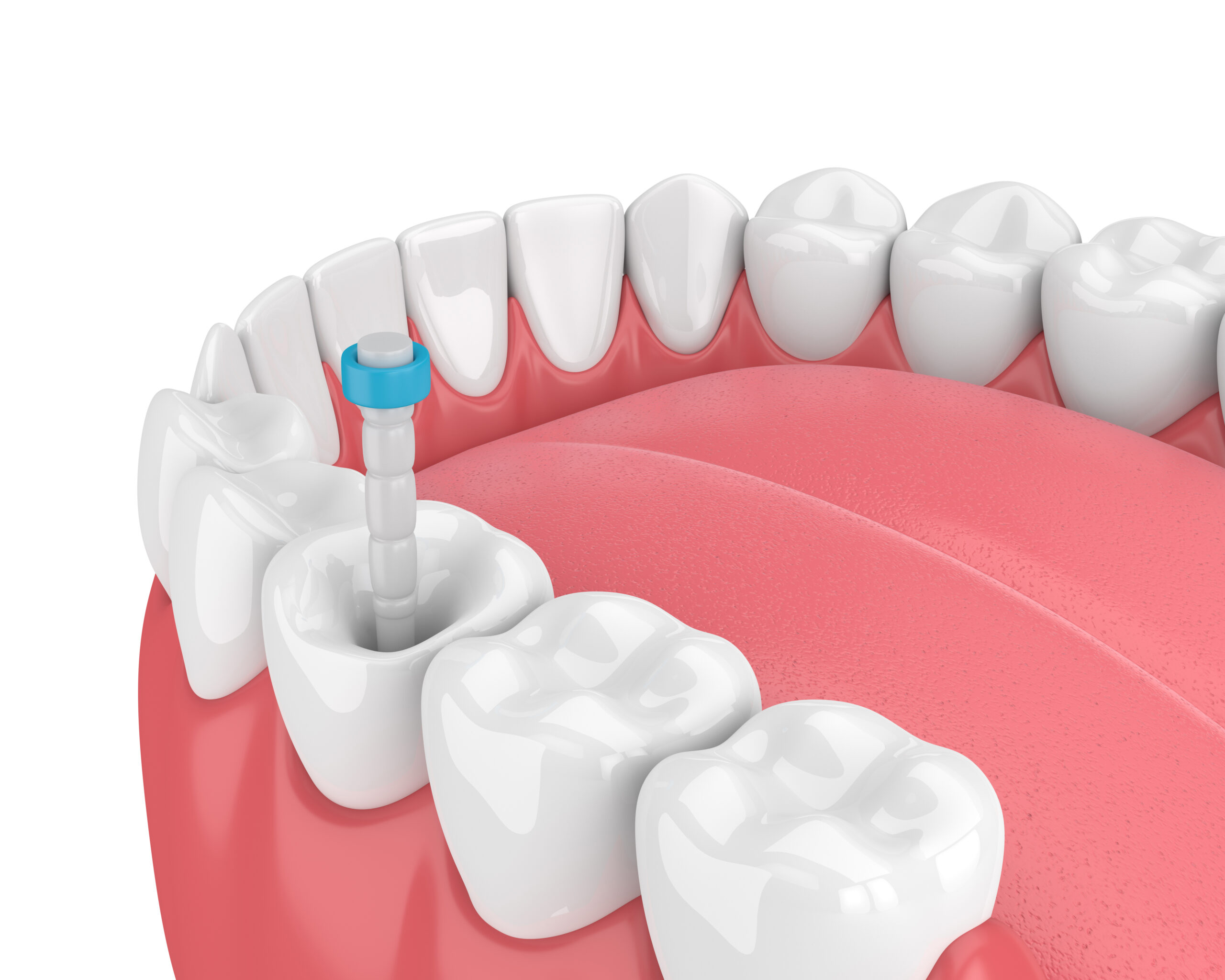 endodonti-1